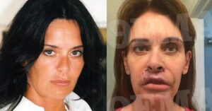 Ελληνίδα συγγραφέας είδε τα χείλη της να «σαπiζουν» μετά από πλαστική επέμβαση