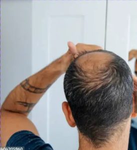 Οι 3 τύποι τριχόπτωσης και οι θεραπείες που πραγματικά βοηθούν